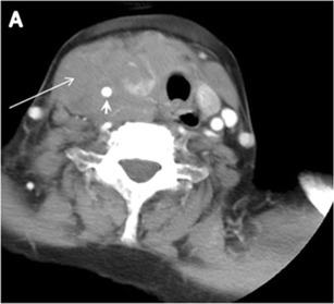 図12：79歳女性患者のびまん性甲状腺大細胞型B細胞リンパ腫。頸部軸方向造影CTスキャンでは、均一に低密度で造影効果が最小限の大きな右甲状腺固形腫瘤（長い白矢印）が甲状腺峡部にまで広がっていることが示されています。この腫瘤は右頸動脈（短い白矢印）を包み込み、気管と食道を左側に移動させています。[1]