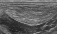 母指球の脂肪腫の医療用超音波検査：隣接する筋肉と比較して高エコーであり、比較的境界明瞭で、微小な高エコー線がみられる。[23]