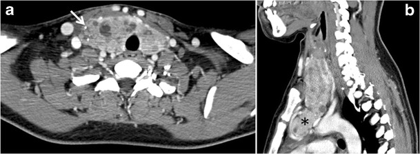 図13。甲状腺腫が判明している27歳の女性患者。a、b 頸部の軸方向および矢状方向のCTスキャン画像では、不均一に増強された腫大した甲状腺と散在する石灰化（白矢印）、嚢胞性変化、および胸骨後部への著しい拡張（黒色のアスタリスク）が認められる。リンパ節腫脹や著しい気道狭窄は認められない。[1]
