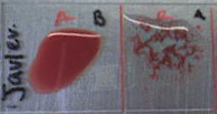 学生の血液検査。3滴の血液を抗B血清（左）と抗A血清（右）に混ぜ合わせます。抗A血清との凝集反応から、この人はA型であることが示唆されます。