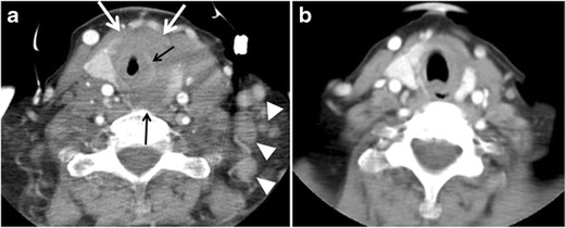 図11。66歳女性患者の甲状腺非ホジキン大細胞型B細胞リンパ腫。a 軸方向の増強頸部CTスキャンでは、左甲状腺葉と峡部に均一に低密度で最小限の増強を示す腫瘤（白矢印）が認められる。この病変は椎前筋に浸潤している（黒矢印）。複数のレベルVリンパ節の腫大（白矢印）に注意。b 治療後の画像では、左甲状腺浸潤腫瘤の大きさと腫瘤効果が大幅に減少し、左頸部リンパ節腫脹がほぼ完全に消失していることがわかる。[1]