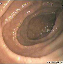 セリアック病患者の十二指腸の内視鏡静止画像。ひだの波状変形が認められる。