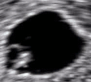 妊娠5週5日で心拍が確認できる胎児