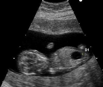 ダウン症候群の胎児の超音波検査で、大きな膀胱が確認できる。