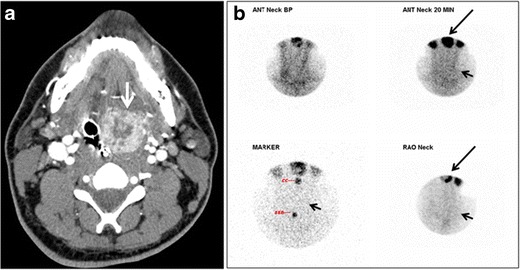 図 18。口腔咽頭出血を呈した 33 歳男性の舌状甲状腺。a 下顎レベルでの軸方向に造影された頸部 CT スキャンでは、3 × 3 × 3.4 cm の円形で、部分的に境界明瞭で、不均一に造影される病変 (白矢印) が認められる。病変は主に口腔咽頭の左側にあり、舌根の中央部にもある程度認められる。甲状腺は正常であった (図示せず)。b Tc99m-ペルテクネチウム酸注射の 20 分後に撮影された前面顔面および頸部の画像では、正常な甲状腺解剖学的位置 (黒の短い矢印) で甲状腺放射性トレーサーの取り込みがみられない。CT スキャンで確認された舌後部の腫瘤に対応して、取り込みが増加した領域 (黒の長い矢印) がある。[1]