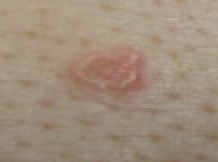 中央皮脂腺増殖症を囲む慢性毛包炎、右胸部中央
