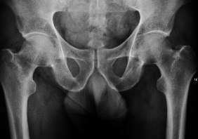 左股関節の一過性骨粗鬆症患者のX線写真。骨粗鬆症がみられる。[1]
