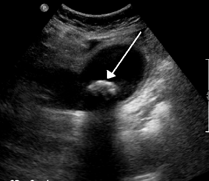 超音波検査で、胆嚢頸部に1.9cmの胆石が嵌頓し、胆嚢炎を引き起こしていることが確認された。胆嚢壁は4mm肥厚している。