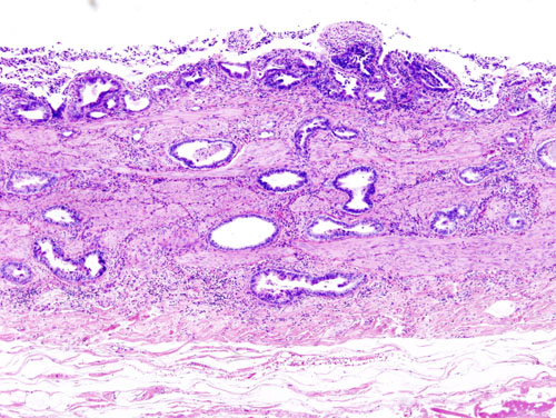 偶然にも、胆嚢摘出術後に胆嚢癌（腺癌）が発見された。