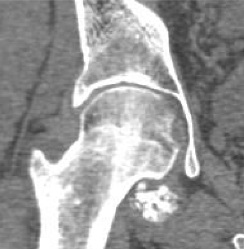 滑膜軟骨腫症のCT[1]