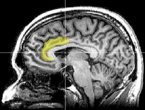 前帯状皮質の位置を示すハイライト付きの MRI 矢状面スライス。