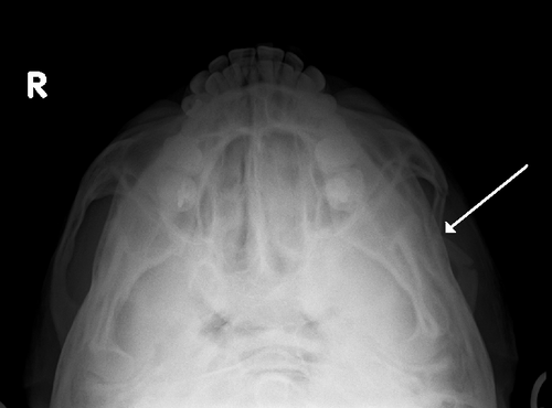 単純X線写真で確認できる頬骨弓骨折