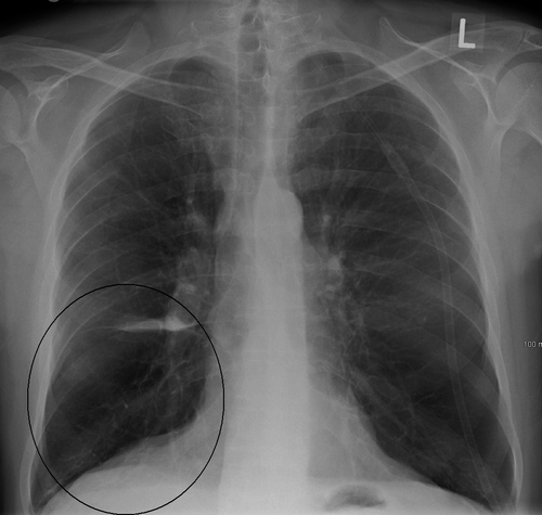重度の慢性閉塞性肺疾患（COPD）患者の胸部X線写真に見られる肺嚢胞
