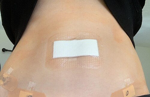 腹腔鏡手術後の女性のへそ。