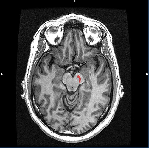 黒質の位置を示すハイライト表示のある水平方向のMRI（T1強調画像）スライス