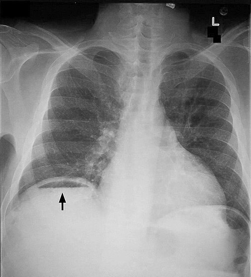 腹部X線検査で横隔膜の下に遊離ガスが認められる。