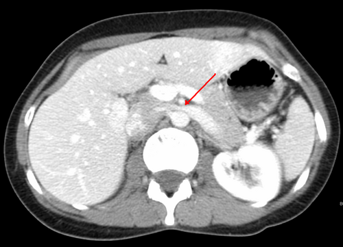 ナットクラッカー症候群により、左腎静脈（矢印で示す）が上腸間膜動脈（上）と大動脈（下）の間で圧迫されている。