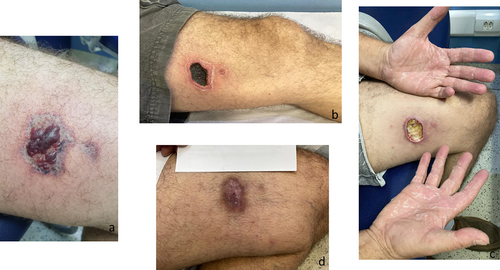 クモに噛まれた後の男性を示す 4 つの画像。画像 a、b、c は進行する壊死を示しています。画像 d は残存する傷跡を示しています。