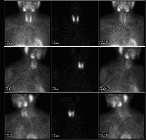 核医学による副甲状腺スキャンでは、甲状腺左下極に隣接する副甲状腺腺腫が認められる。上記の検査は、テクネチウムセスタミビ（1列目）とヨウ素123（2列目）を用いた同時撮像と差分法（3列目）によって実施された。