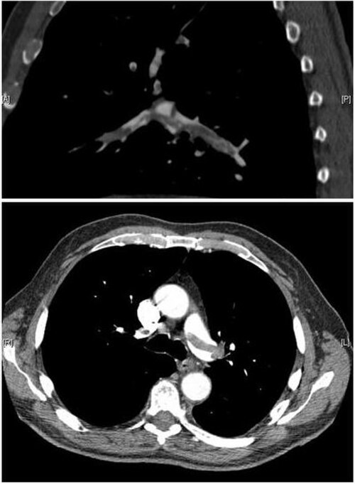 CT 肺血管造影では、主肺動脈の分岐部に「鞍型塞栓」が見られ、両側の肺葉動脈に血栓が蓄積していることがわかります。