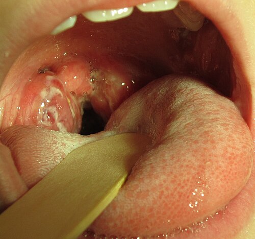 喉の奥にある大きな扁桃腺が白い滲出液で覆われています。これは、典型的な扁桃腺滲出液を伴う、培養陽性の連鎖球菌性咽頭炎の 8 歳児の症例です。