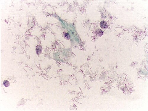 扁平上皮細胞の細胞質が溶け出し、デーデルライン桿菌が多数見られます。