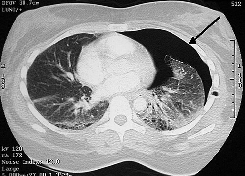 胸部のコンピューター断層撮影(CT)スキャンの画像。患者の右側(左側)に、胸部内に自由空気があることを示す黒い領域がある。