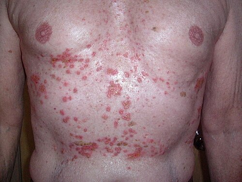 成人の胸部と腹部に多数の赤い皮膚病変がある