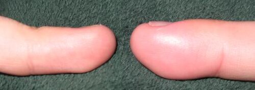右手指の末節骨に、急性爪囲炎による浮腫が見られる。