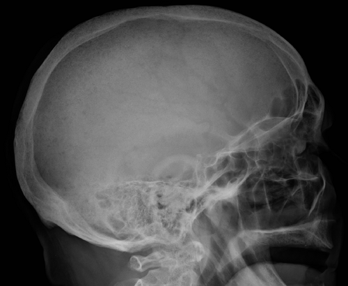 多発性骨髄腫による複数の透過像を示す頭蓋骨X線写真