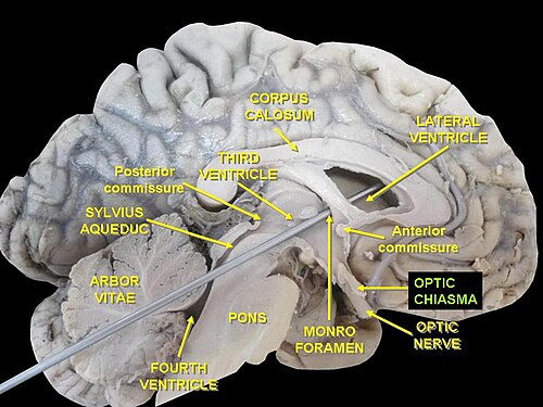 死体標本の側面から見た脳の左半球。視交叉がラベル付けされている。