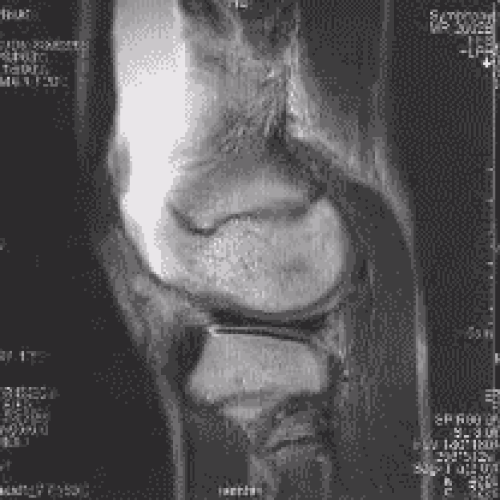 膝のMRI