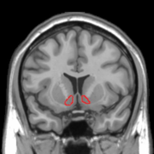 MRI 冠状断面では、赤く縁取られた側坐核が示されています。