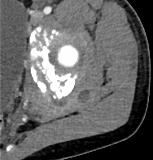 12 歳の健康な男児の CT 検査で、左の小殿筋に多房性の液体貯留が見られ、黄色ブドウ球菌による化膿性筋炎であることが判明しました。