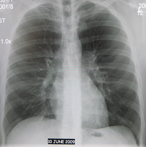 正常AP CXR