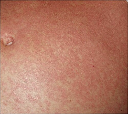 急性アフリカトリパノソーマ症によく見られる、腹部の皮膚に現れる細かい斑点状のピンク色の発疹（「トリパノソーマ発疹」）。