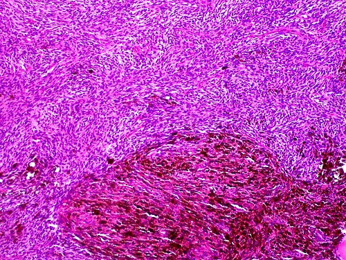 腫瘍の下にヘモジデリンが沈着する