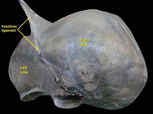 死体の肝臓を上から見た図。上部に鎌状靭帯が見える。