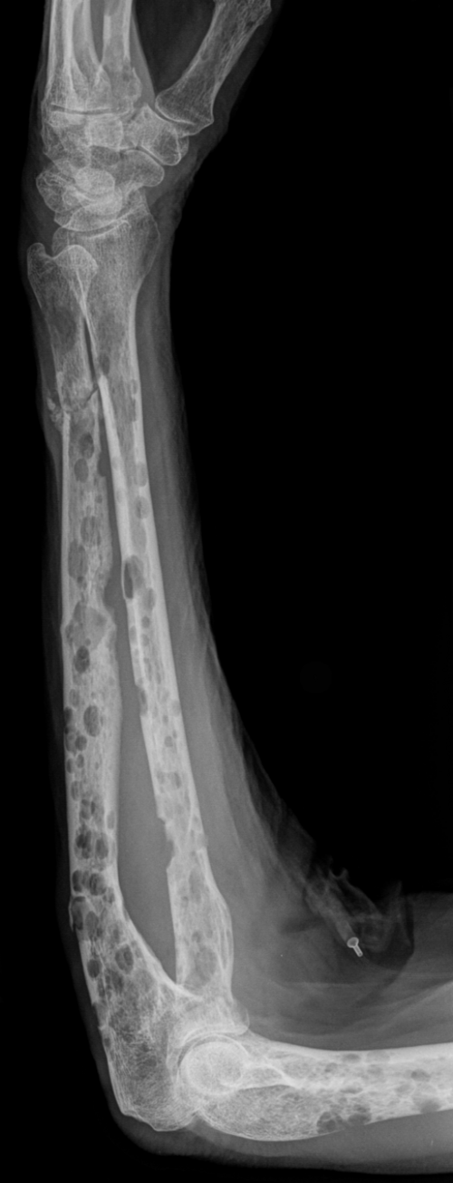 前腕のX線写真、溶骨性病変あり