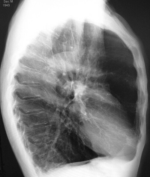 肺気腫患者の胸部側面X線写真。樽状胸郭と平坦な横隔膜が認められる。