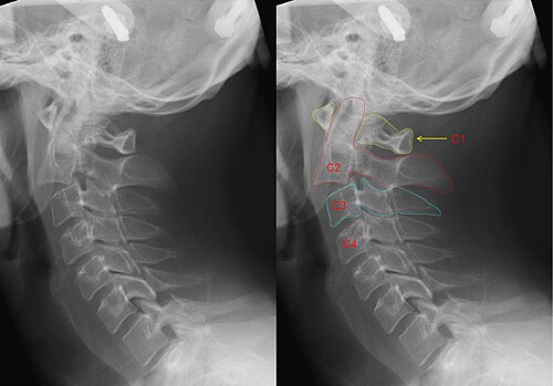 2枚のX線写真。首の正常な位置と、絞首縄による典型的な骨折が示されています。