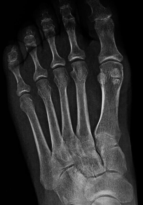 成人女性の左足の親指の第 1 中足指節関節の下にある二分された内側種子骨。