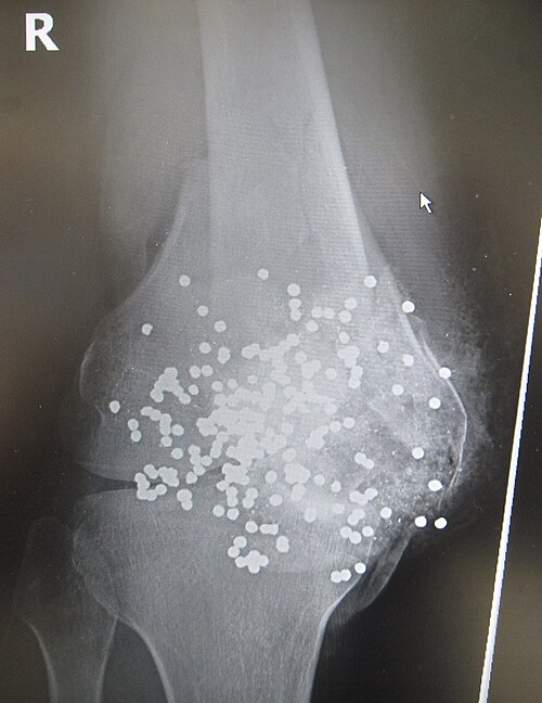 至近距離からの散弾銃による膝の負傷のレントゲン写真。粉砕された膝蓋骨、大腿骨遠位部、脛骨近位部の内部および周囲に散弾が確認できる。