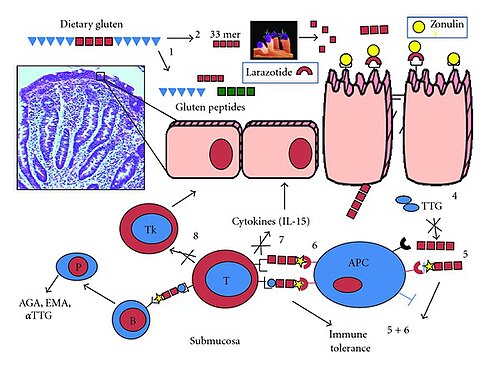 腸内におけるセリアック病の発症メカニズムを視覚的に説明した図解