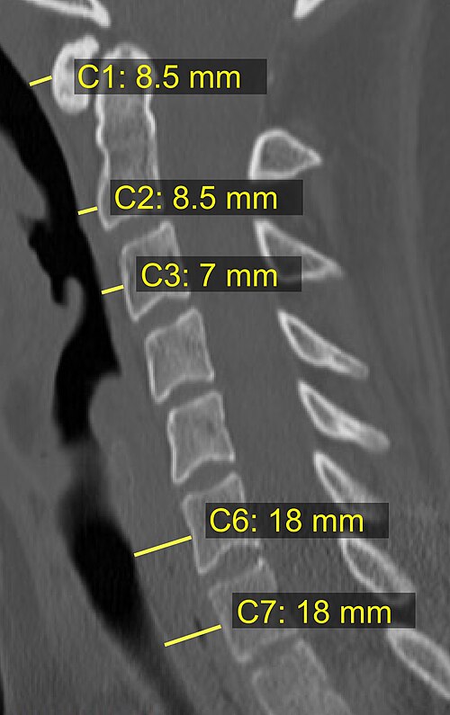 CTスキャン画像における、異なるレベルでの椎前腔の厚さの上限値