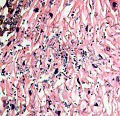 食道粘膜固有層内にカンジダ菌糸が認められる食道のH&E染色像