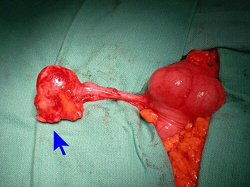 虫垂先端部の粘液性腺癌