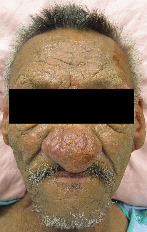 大きくて赤い球根状の鼻を持つ成人男性