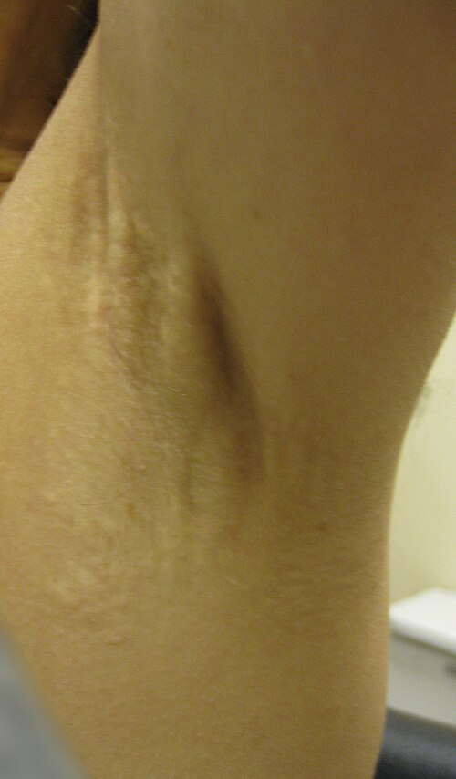 左腋窩の弾性線維性偽黄色腫。