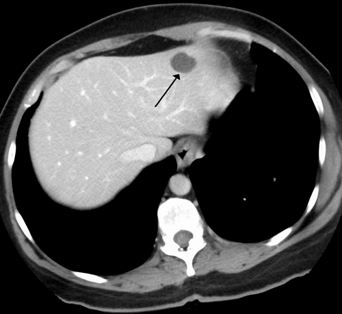 CTで観察された肝臓血管腫
